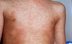 Read more about the article Measles — Some Facts