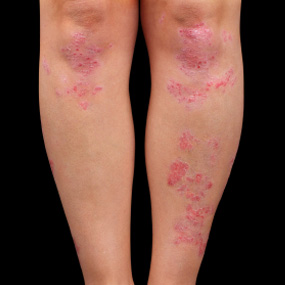 Homeopathy and Psoriasis